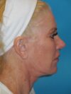 Blepharoplasty case #5235