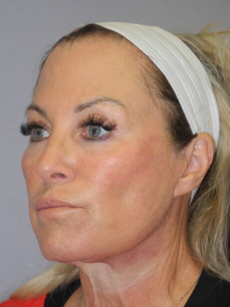 Blepharoplasty case #5252