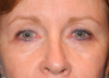 Blepharoplasty case #4986