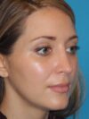 Rhinoplasty case #3685