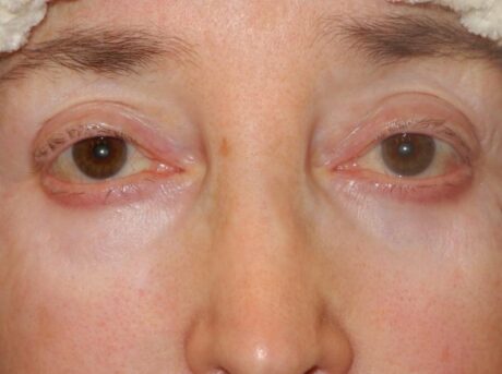 Blepharoplasty case #3843