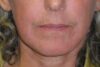 Blepharoplasty case #3982