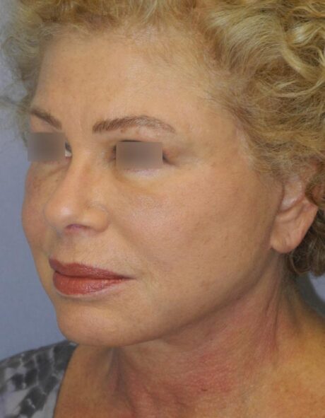 Blepharoplasty case #3989