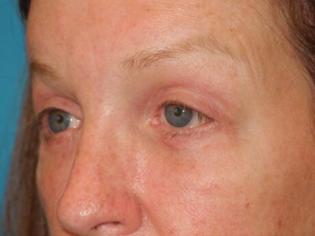 Blepharoplasty case #4024