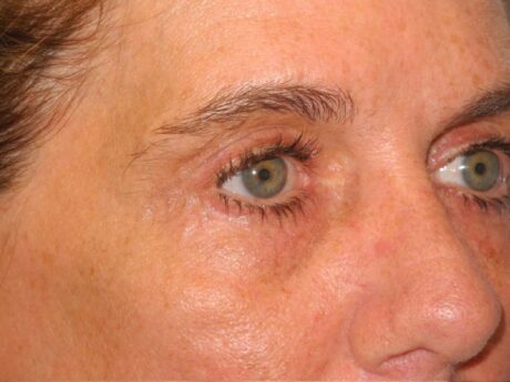 Blepharoplasty case #6472