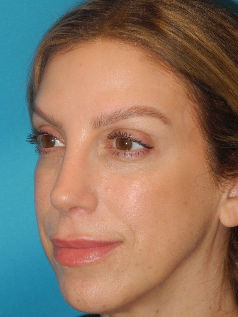 Revision Rhinoplasty case #3465