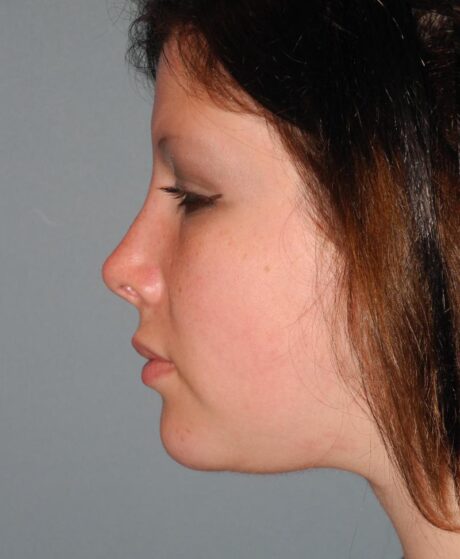 Chin Implant case #4121