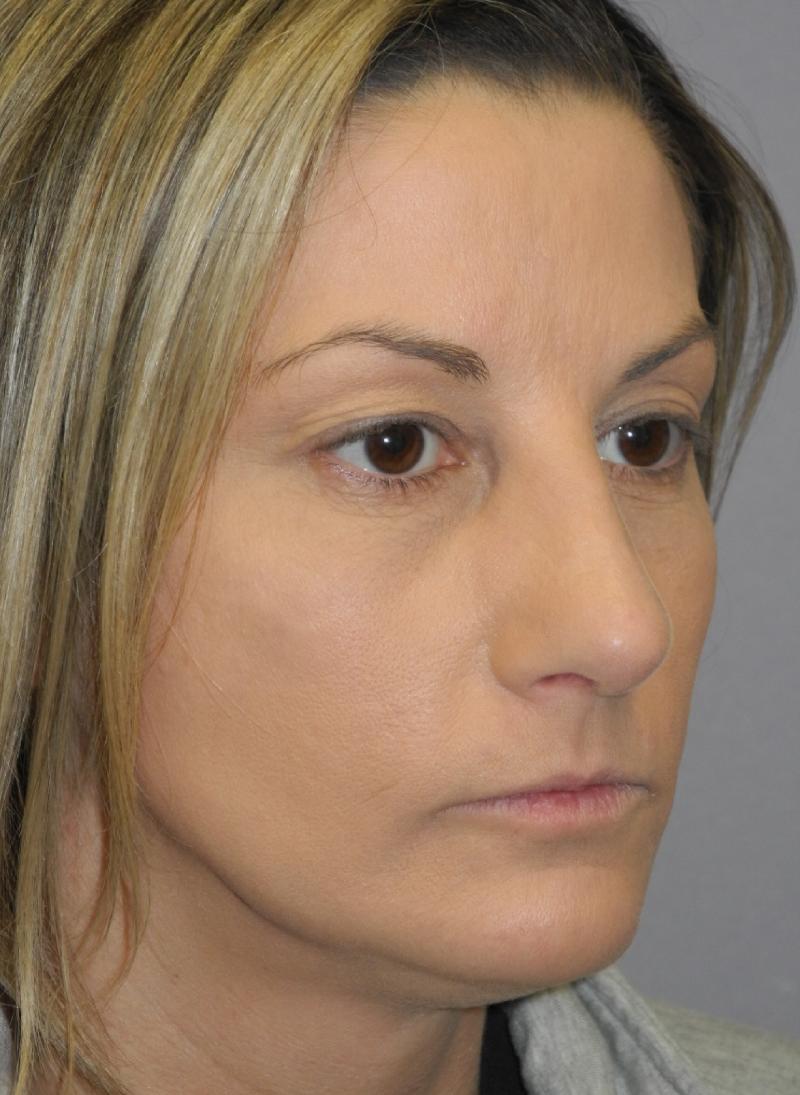 Rhinoplasty case #4123