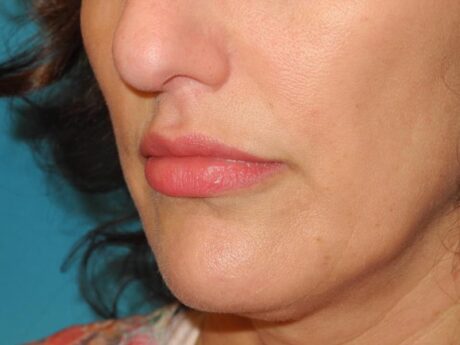 Lip Lift case #4218