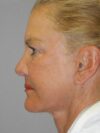 Revision Rhinoplasty case #3493