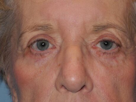 CO2 Laser Resurfacing case #4539