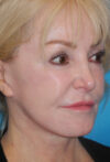 CO2 Laser Resurfacing case #4635