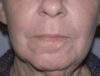 CO2 Laser Resurfacing case #4637