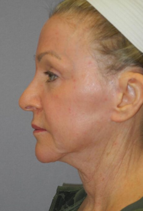 CO2 Laser Resurfacing case #4681