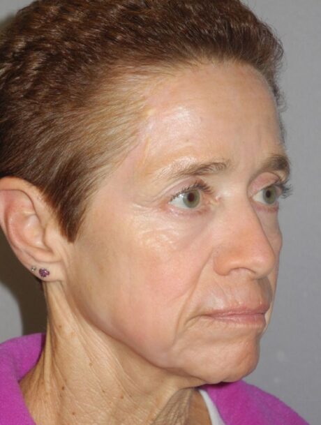 CO2 Laser Resurfacing case #4749