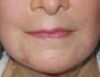 CO2 Laser Resurfacing case #4750