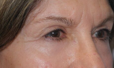 CO2 Laser Resurfacing case #4752