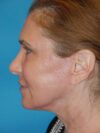 CO2 Laser Resurfacing case #4753