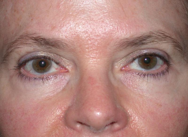 Blepharoplasty case #6470