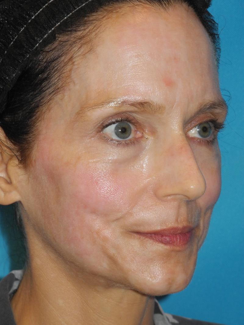 CO2 Laser Resurfacing case #4755