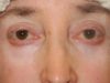 Blepharoplasty case #4858