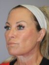 CO2 Laser Resurfacing case #4756