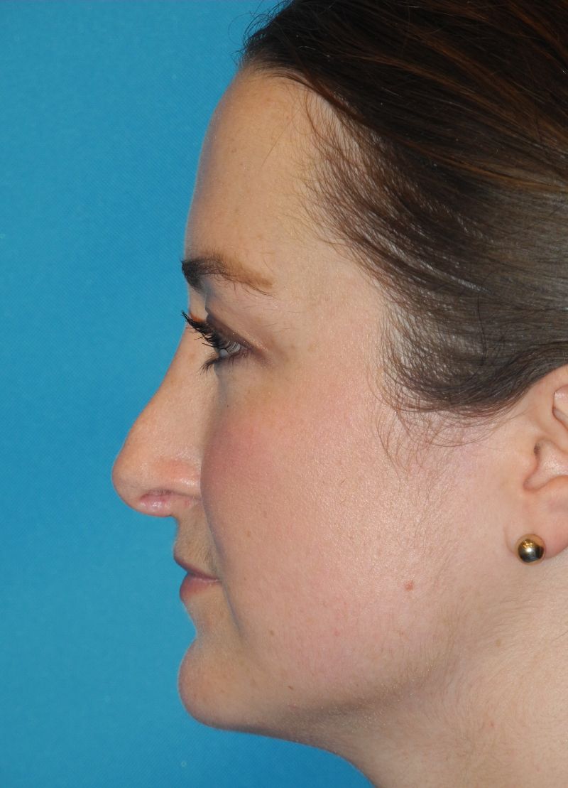 Revision Rhinoplasty case #3453