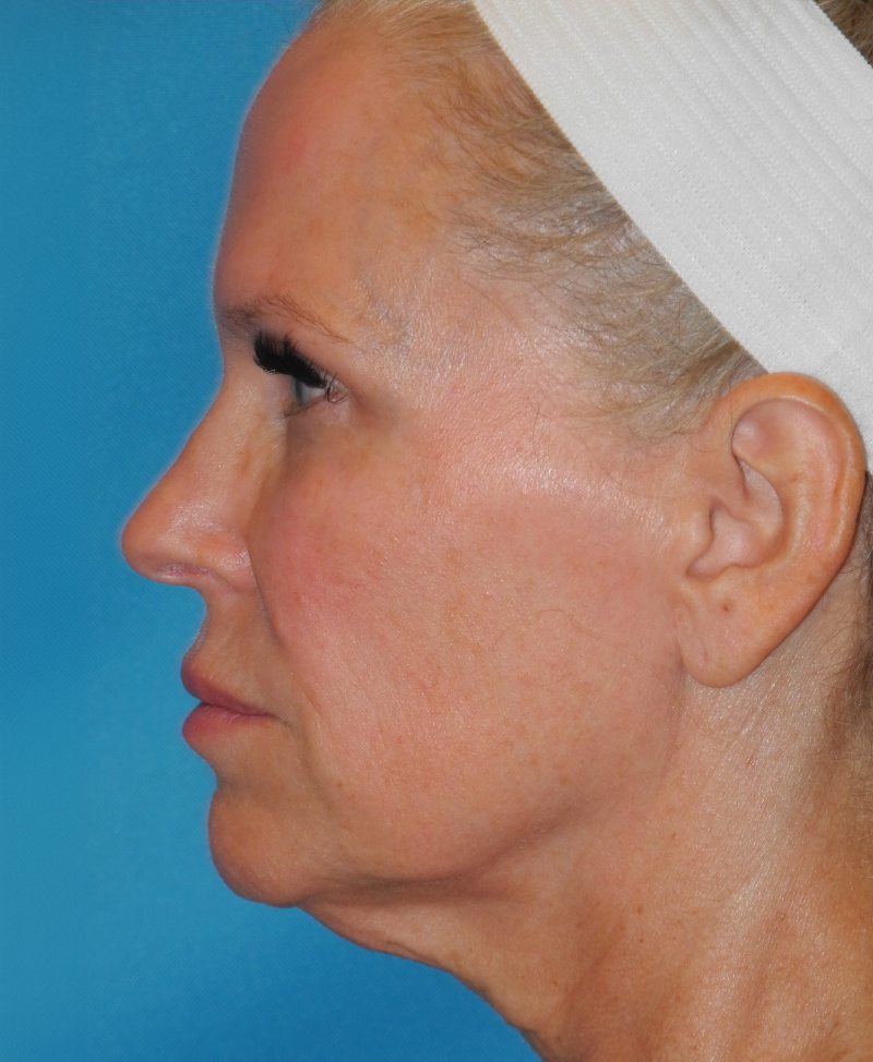 Blepharoplasty case #3927