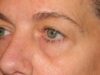 Blepharoplasty case #4034