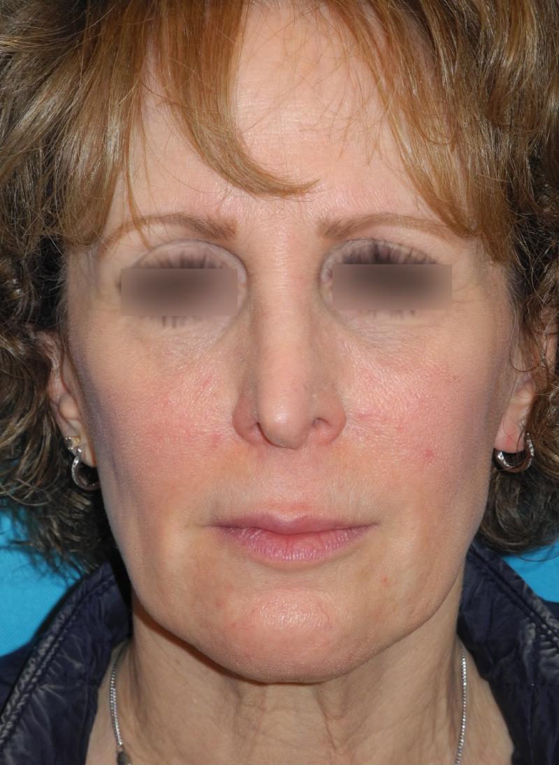 Revision Rhinoplasty case #3464