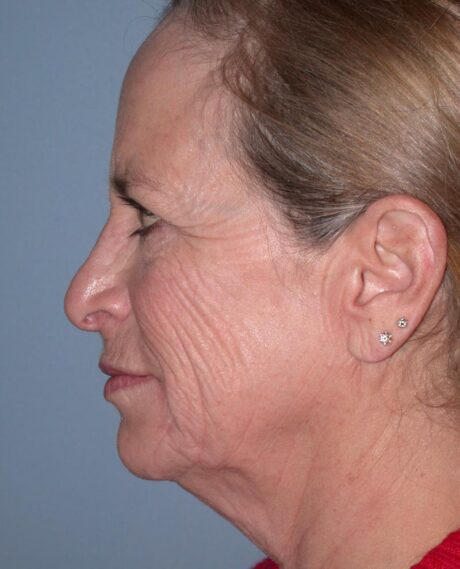 CO2 Laser Resurfacing case #4537