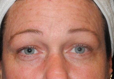 CO2 Laser Resurfacing case #4586