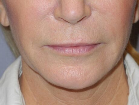 CO2 Laser Resurfacing case #4682