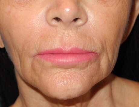 CO2 Laser Resurfacing case #4686