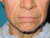 CO2 Laser Resurfacing case #4749