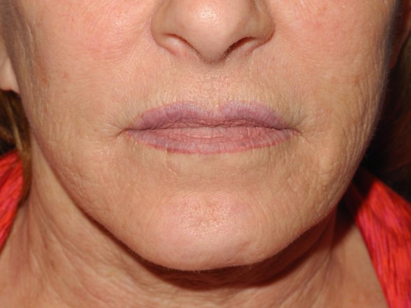 CO2 Laser Resurfacing case #4753