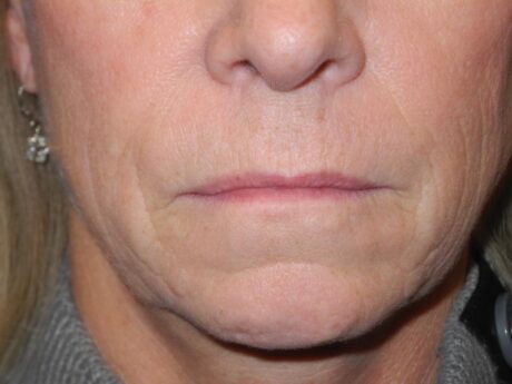 CO2 Laser Resurfacing case #4754