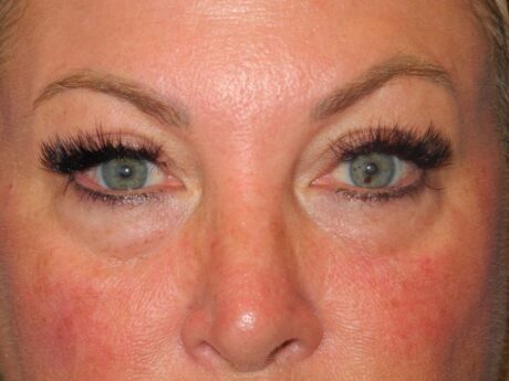 CO2 Laser Resurfacing case #4756