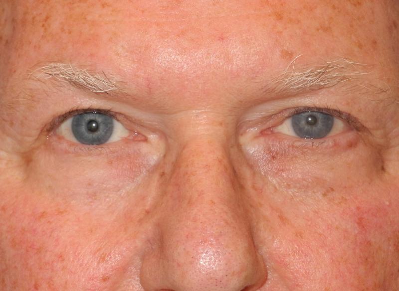 Blepharoplasty case #5211