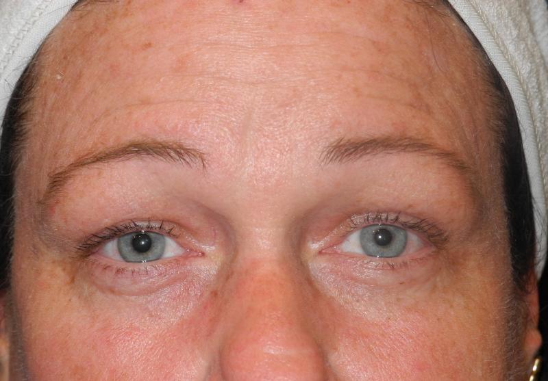 Blepharoplasty case #5225