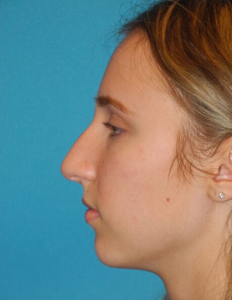 Rhinoplasty case #3523