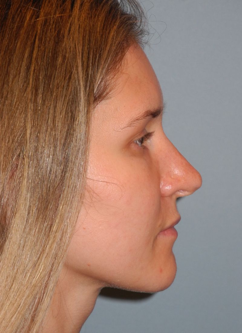 Revision Rhinoplasty case #3435