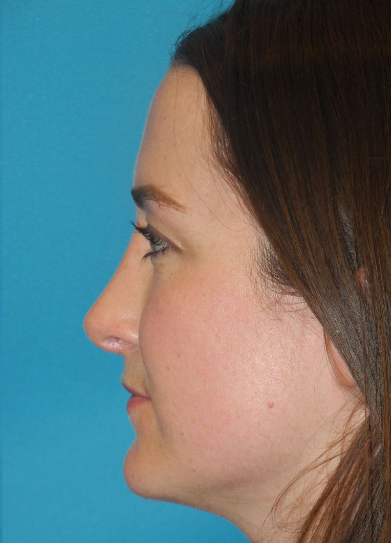 Revision Rhinoplasty case #3453