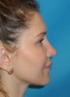 Revision Rhinoplasty case #3435