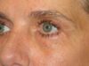 Blepharoplasty case #4034