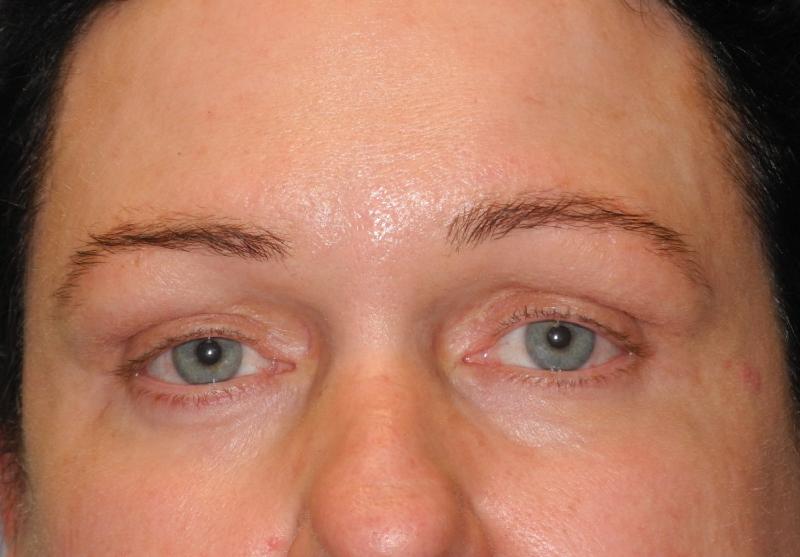 CO2 Laser Resurfacing case #4586