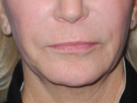 CO2 Laser Resurfacing case #4682