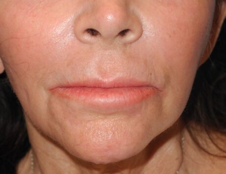 CO2 Laser Resurfacing case #4686