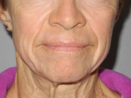 CO2 Laser Resurfacing case #4749