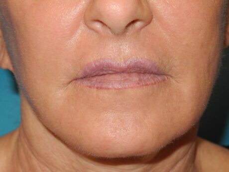 CO2 Laser Resurfacing case #4753